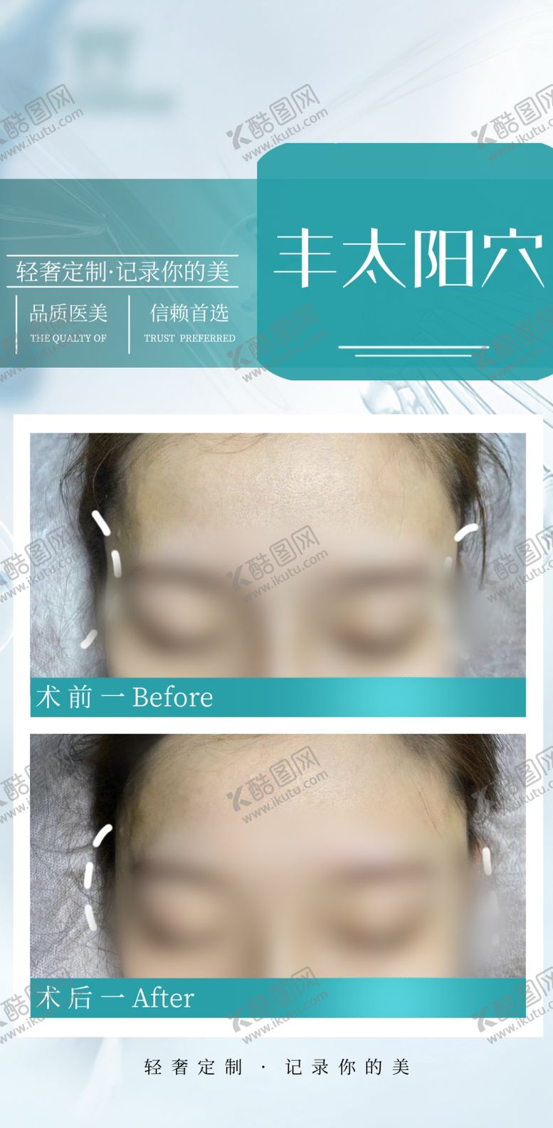 编号：72900801250758385208【酷图网】源文件下载-丰太阳穴案例对比