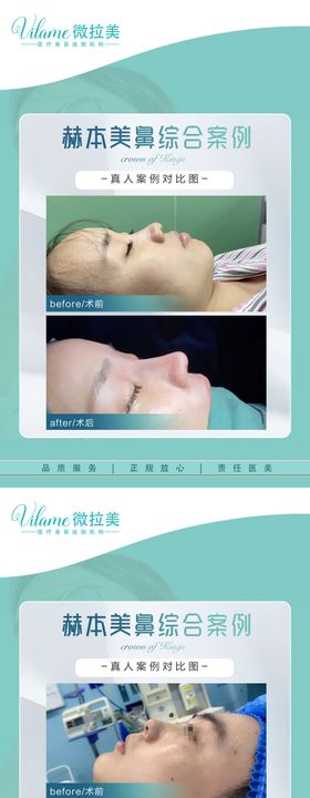 医美案例对比海报