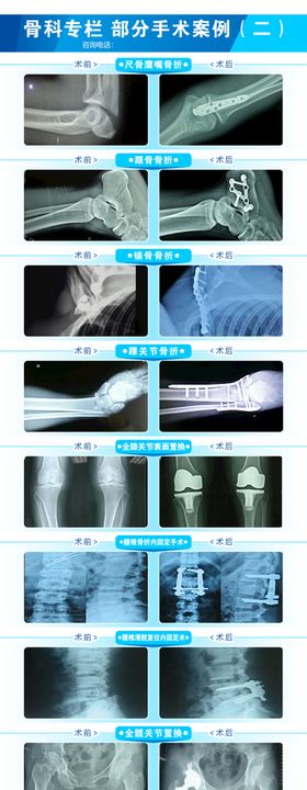 骨科手术案例展示