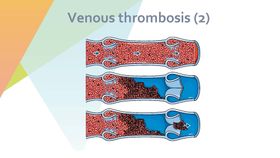 静脉血栓