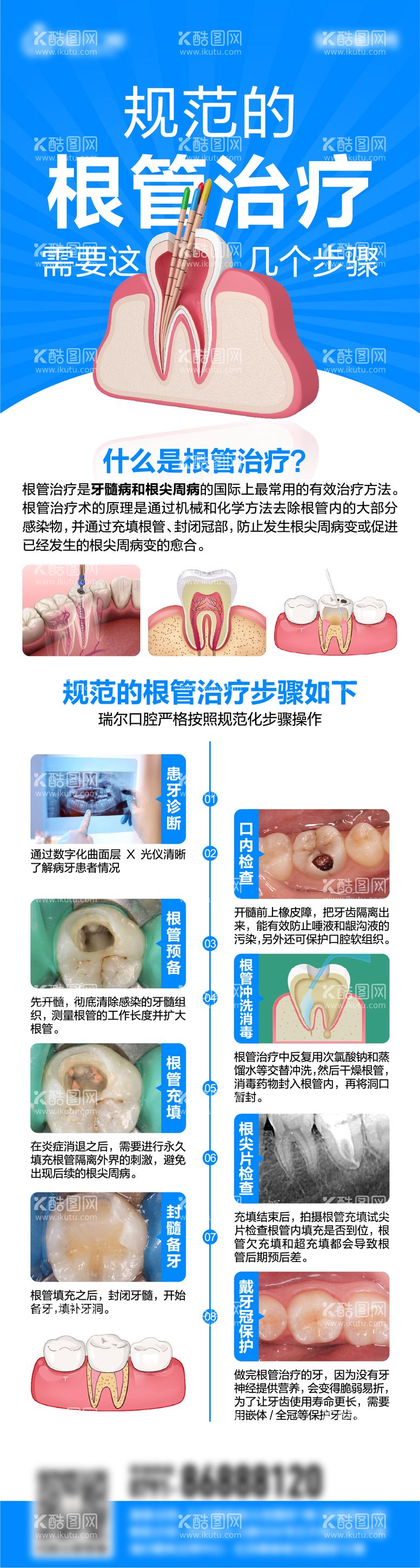 编号：61830512051949258021【酷图网】源文件下载-根管治疗流程