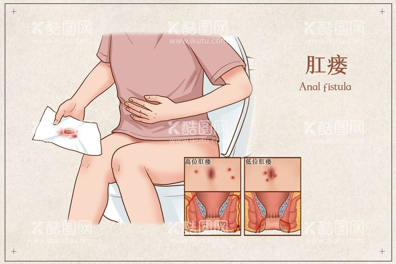 编号：26153709191631125360【酷图网】源文件下载-肛瘘