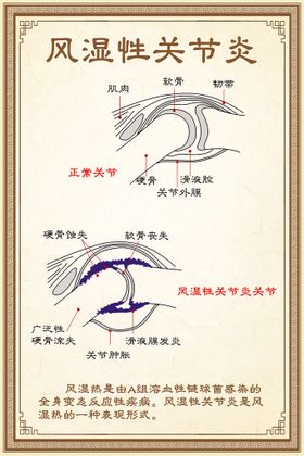 风湿性关节炎