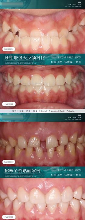 口腔案例对比系列海报展板