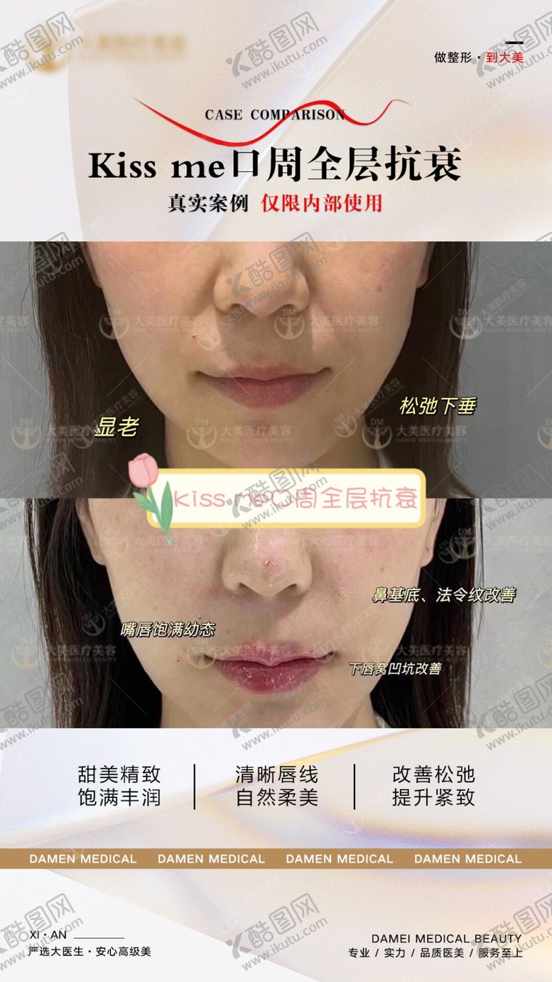 编号：36284301181923441426【酷图网】源文件下载-口周抗衰案例对比