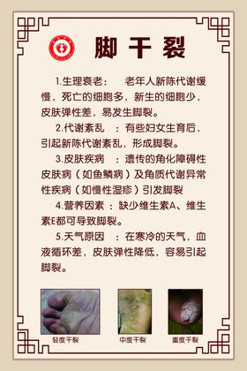 脚干裂