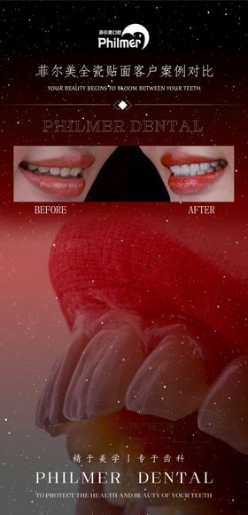 口腔牙贴面海报