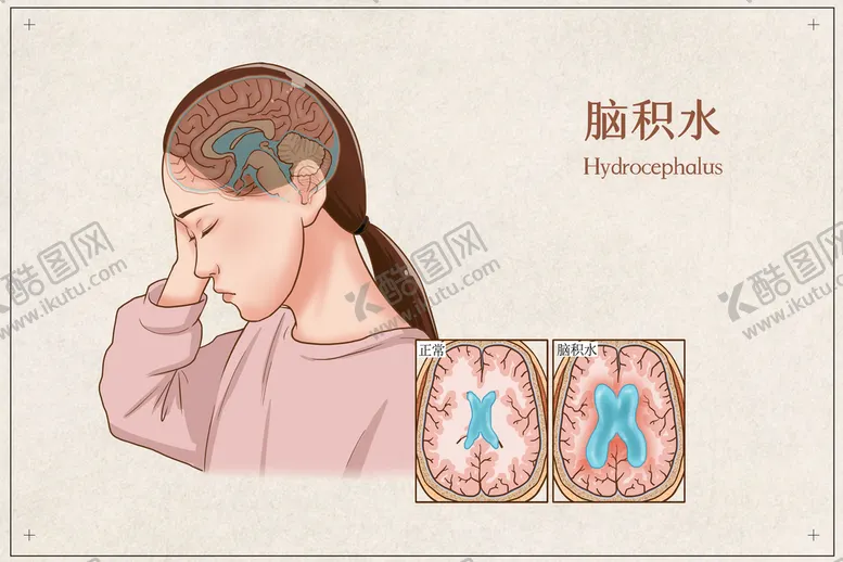 编号：97012509211408131425【酷图网】源文件下载-脑积水