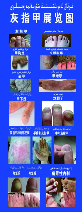 灰指甲展览图