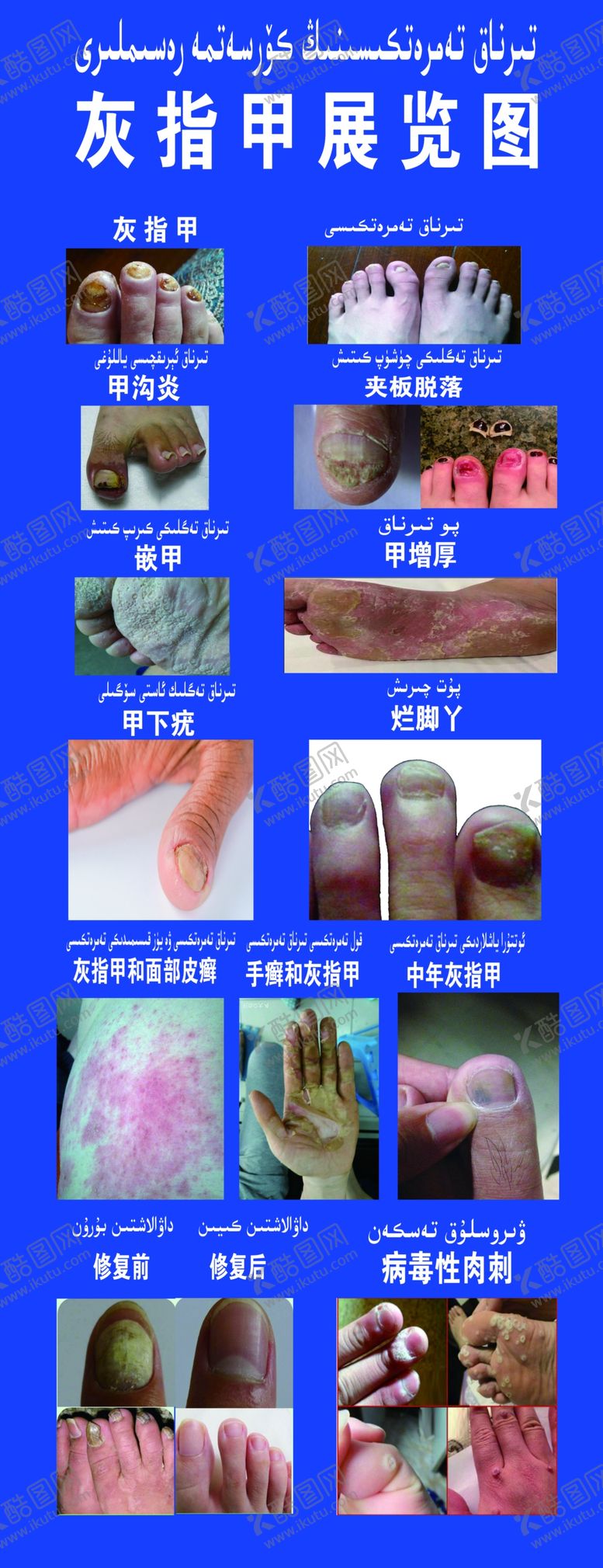 编号：46670206281026298388【酷图网】源文件下载-灰指甲展览图