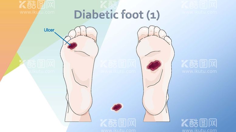 编号：34692401241301546986【酷图网】源文件下载-糖尿病足