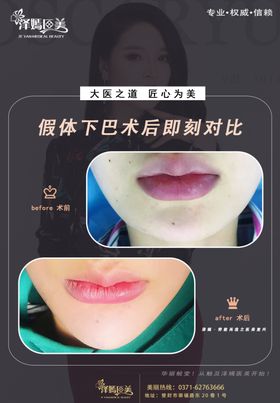 医美整形下巴