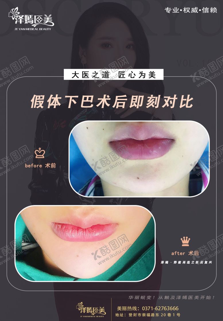 编号：35329407041544375861【酷图网】源文件下载-医美整形下巴
