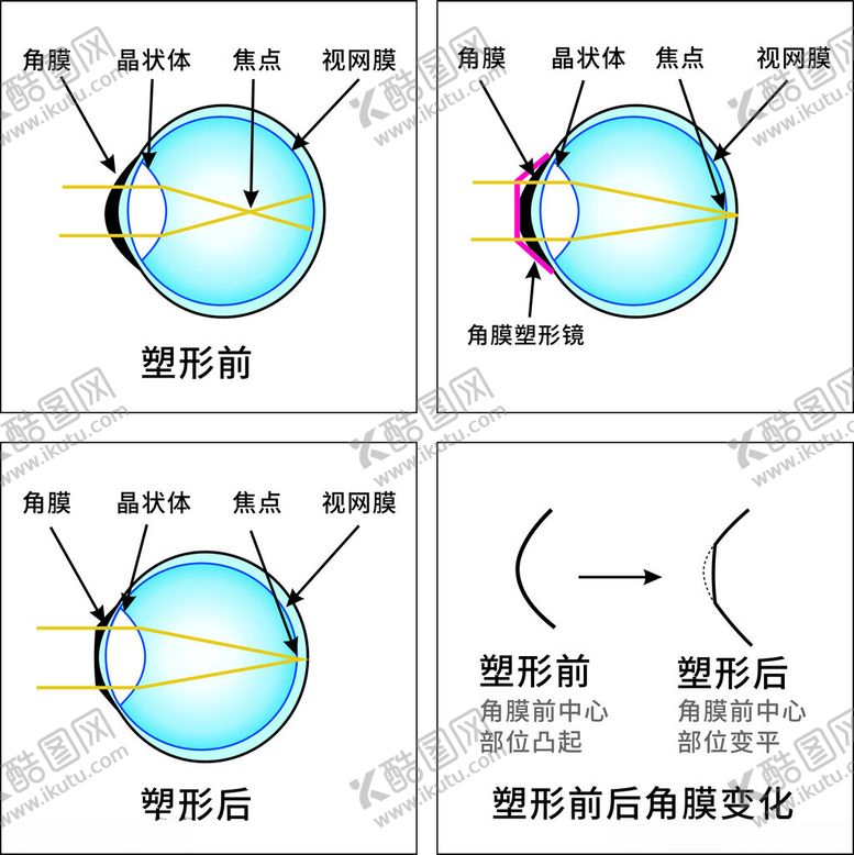 编号：15301801170222387596【酷图网】源文件下载-角膜塑形镜工作原理
