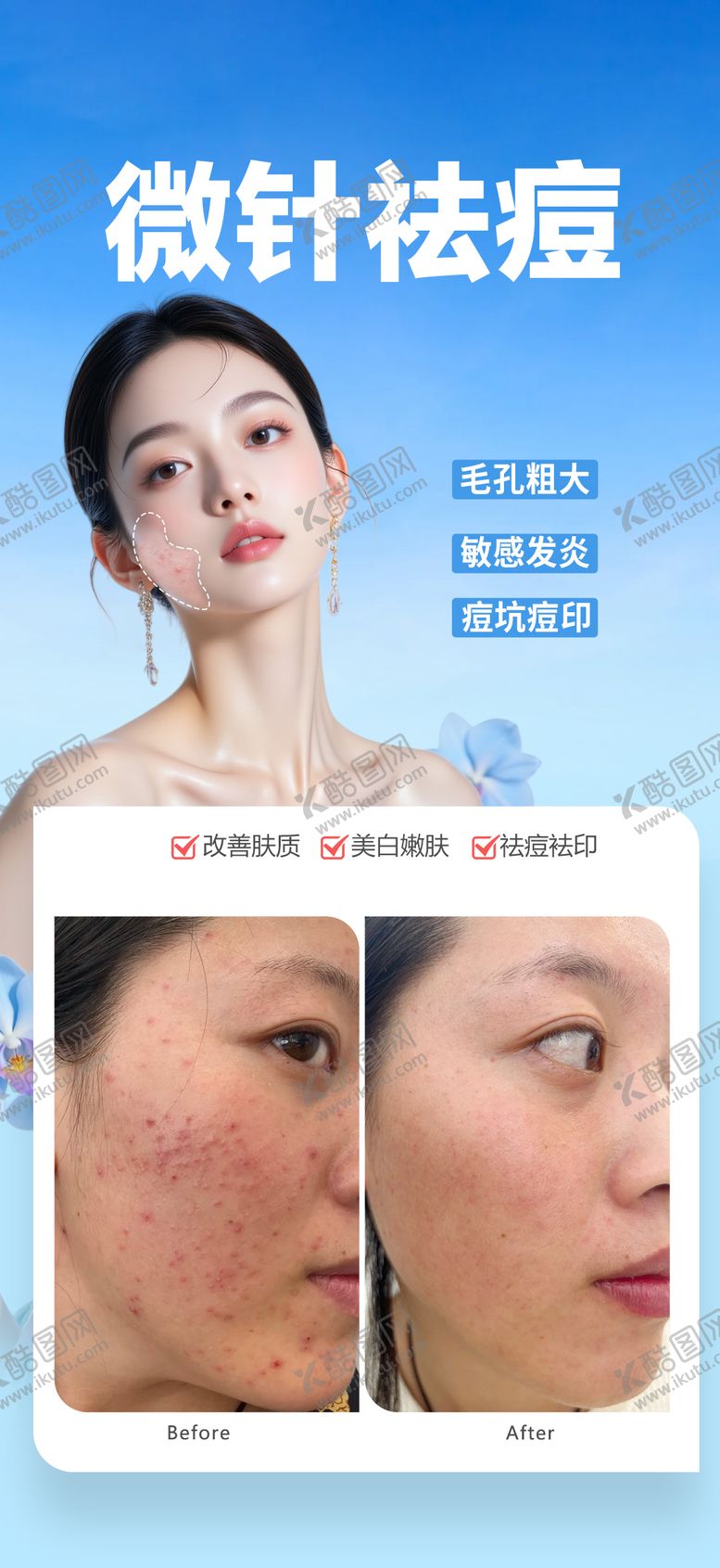 编号：74968710011627249013【酷图网】源文件下载-医美微针祛痘海报