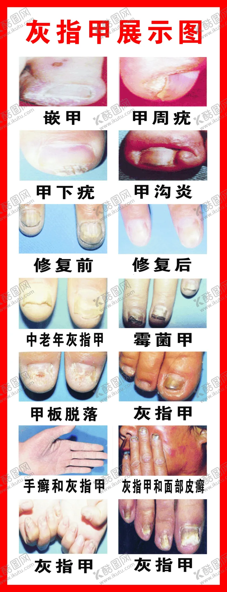 编号：53454612012254474826【酷图网】源文件下载-灰指甲展示图