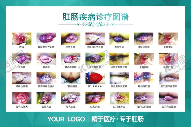 编号：28353706302217245292【酷图网】源文件下载-肛肠疾病诊疗图谱