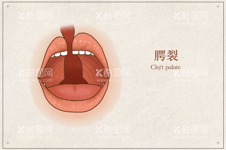 编号：75455512031327078527【酷图网】源文件下载-腭裂