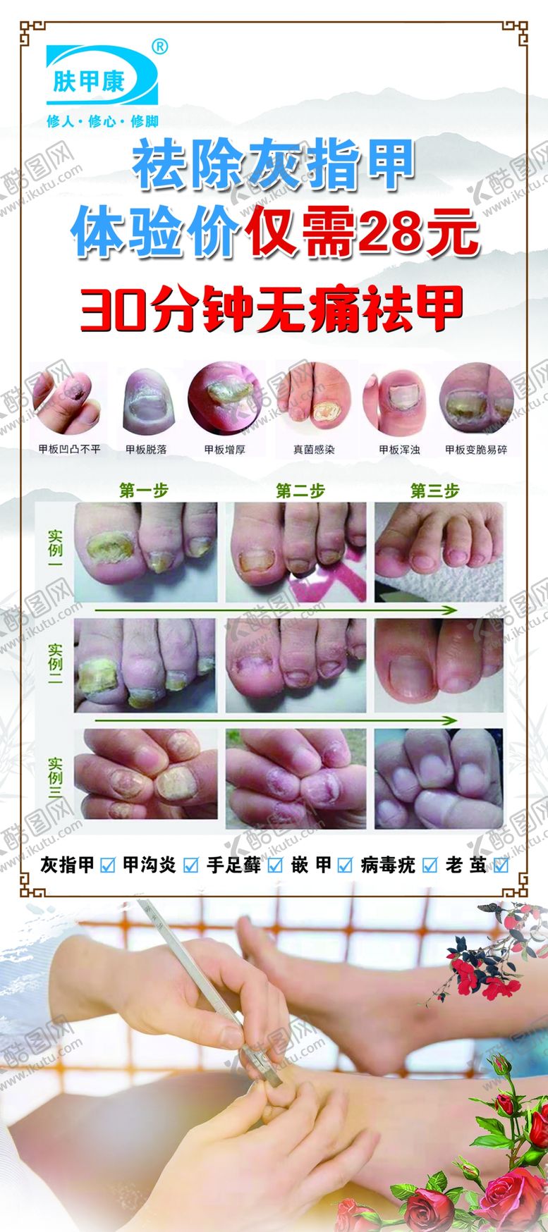 编号：31503601251043118066【酷图网】源文件下载-肤甲康灰指甲甲沟炎