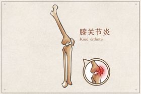 编号：90287410011837133560【酷图网】源文件下载-膝关节炎