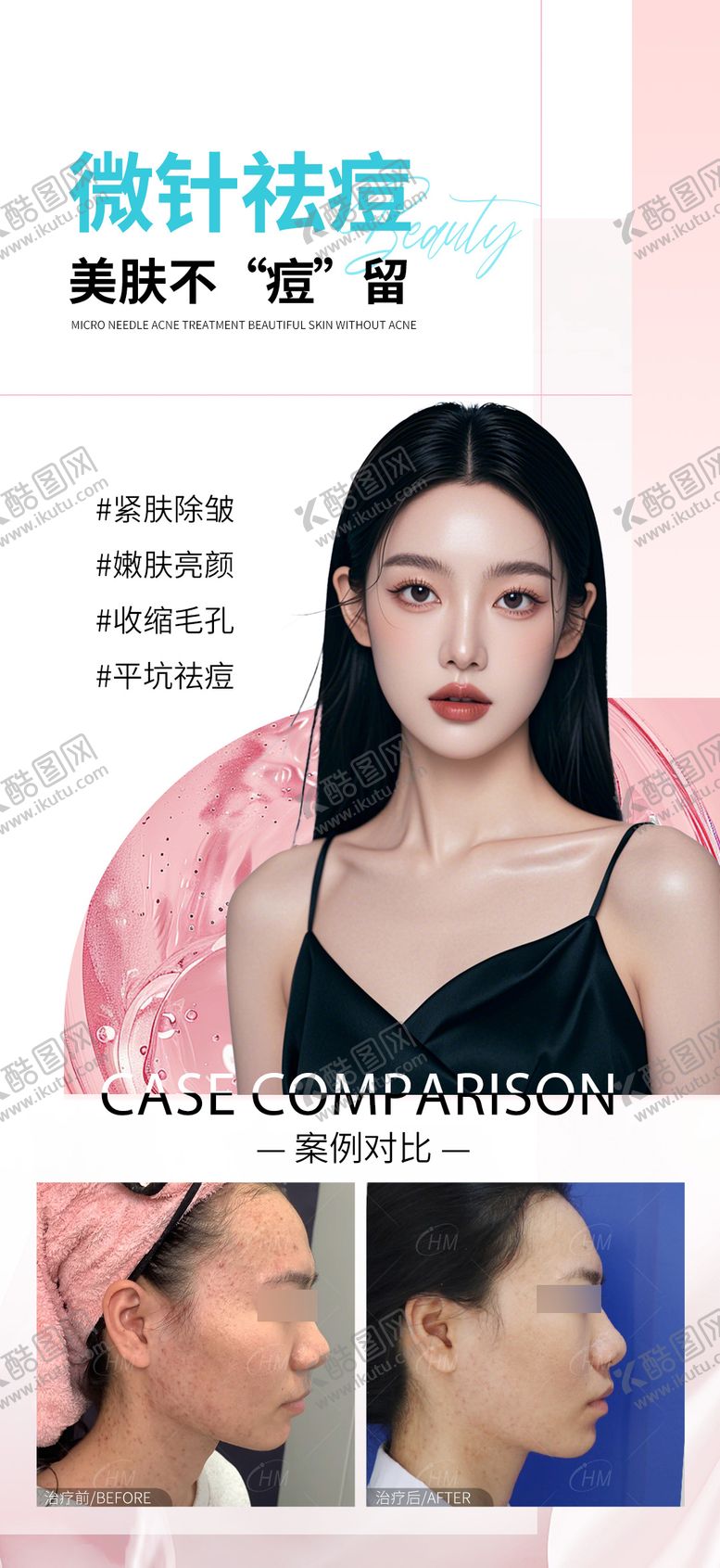 编号：79356906231832562842【酷图网】源文件下载-微针祛痘医美海报