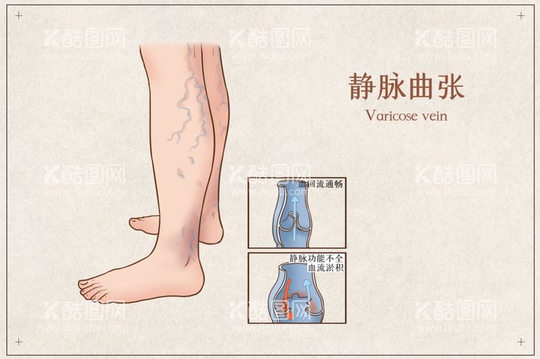 编号：14674112301419366295【酷图网】源文件下载-静脉曲张