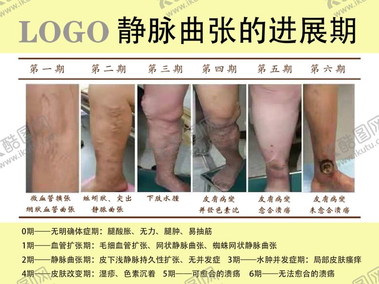 编号：34937809230515459273【酷图网】源文件下载-静脉曲张