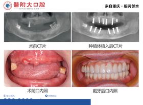 口腔瓷贴面案例海报