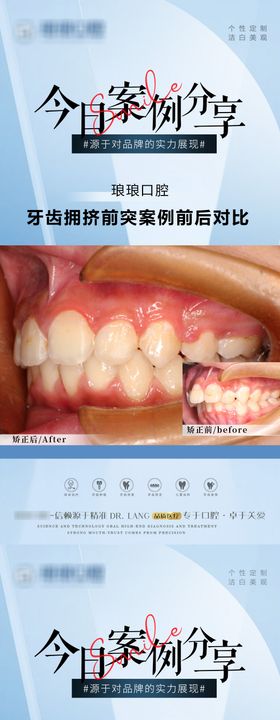 口腔牙齿贴片案例海报