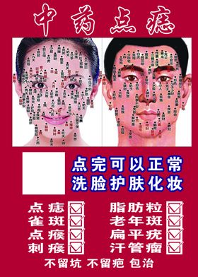 中药点痣