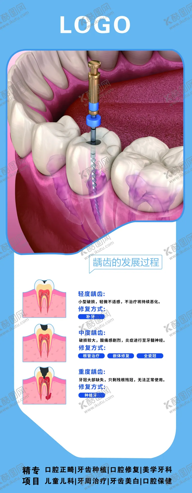 编号：96313802202232298732【酷图网】源文件下载-口腔根管治疗