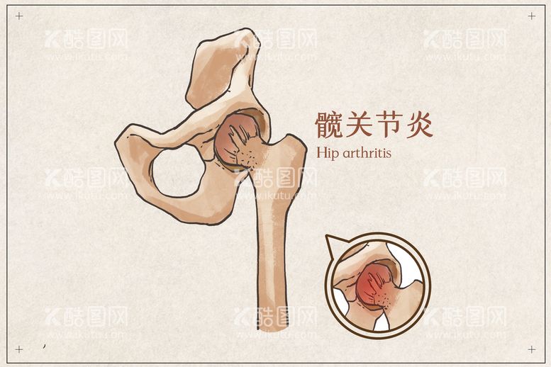 编号：23154711182256266087【酷图网】源文件下载-髋关节炎