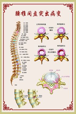 腰椎间盘突出病变