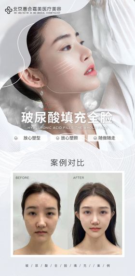 玻尿酸案例对比海报