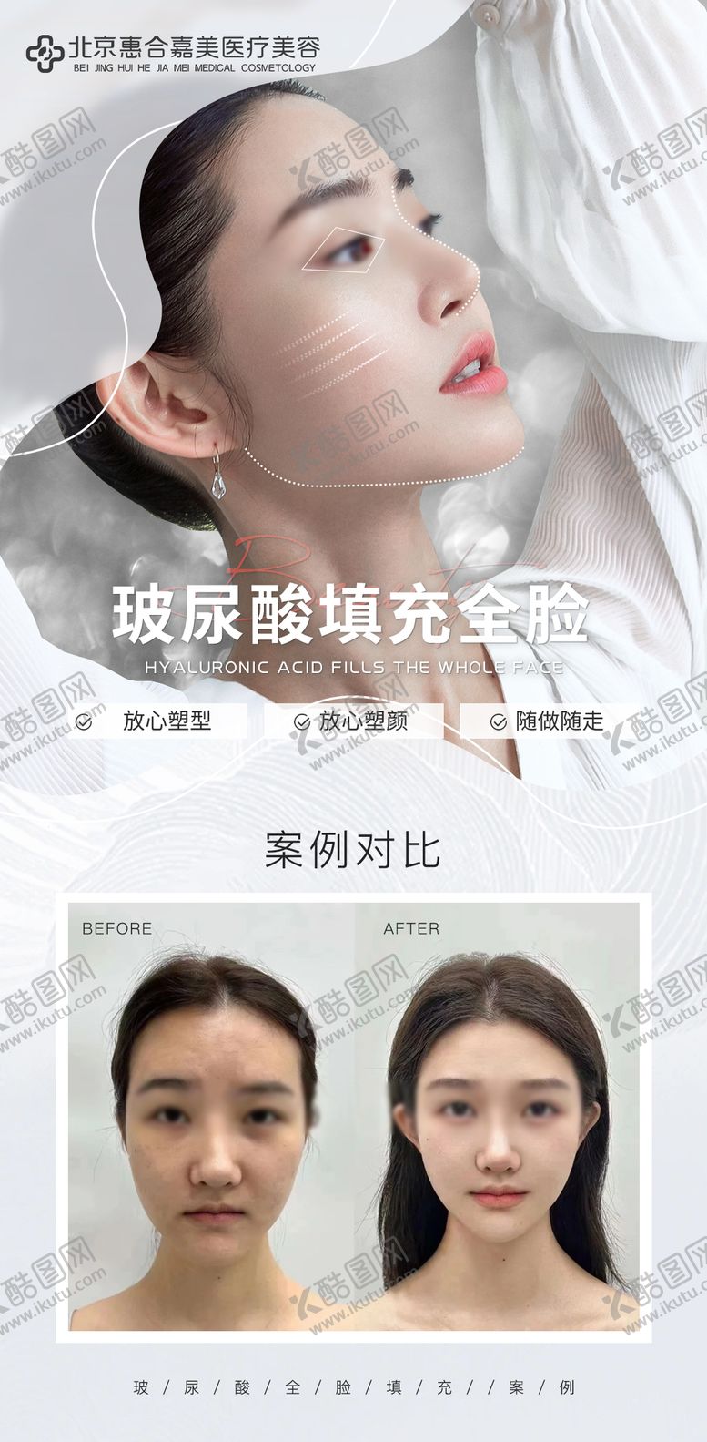 编号：48869512131312247841【酷图网】源文件下载-玻尿酸案例对比海报