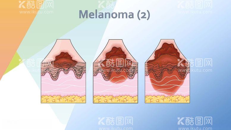 编号：36275412180927335571【酷图网】源文件下载-黑色素瘤