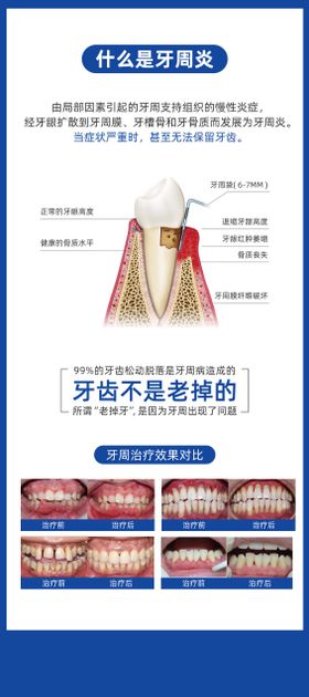 口腔牙周炎科普宣传展架