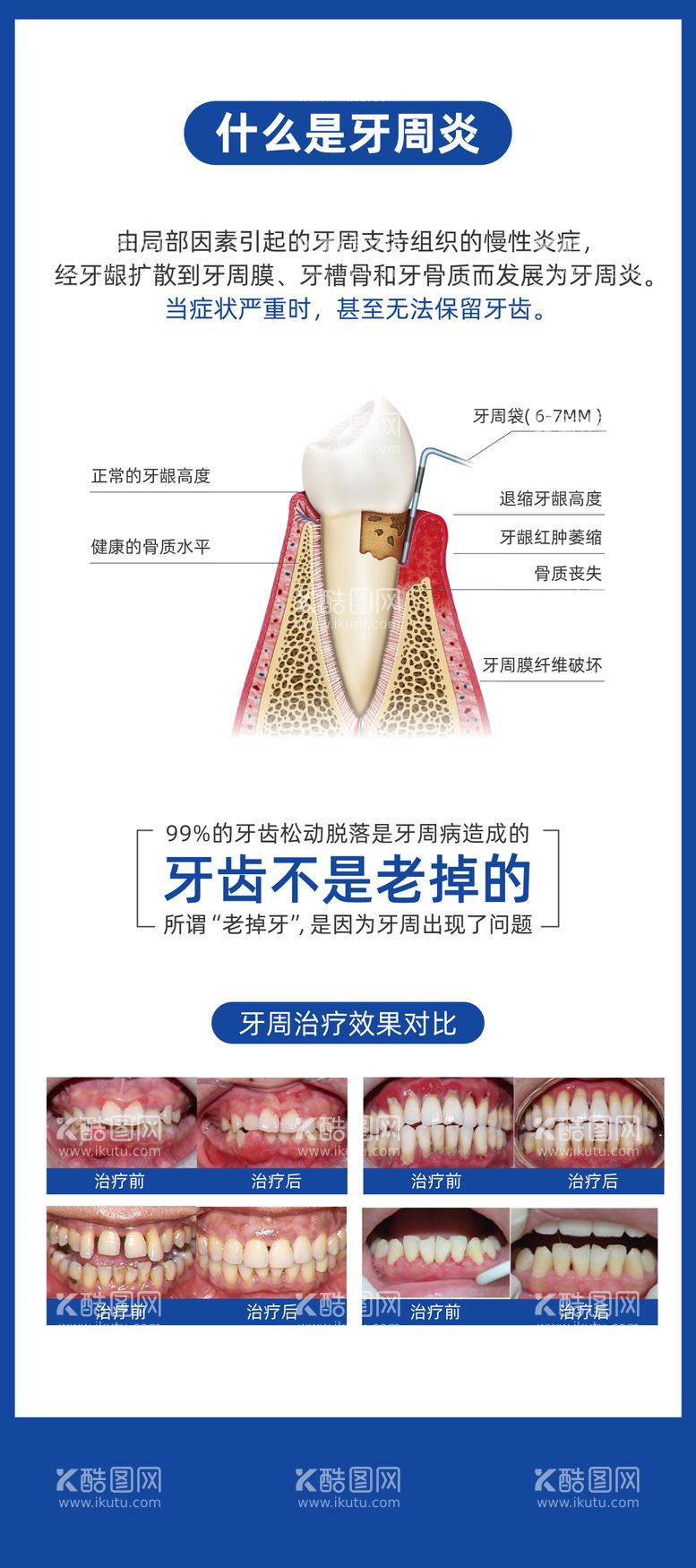 编号：39256811201211506021【酷图网】源文件下载-口腔牙周炎科普宣传展架