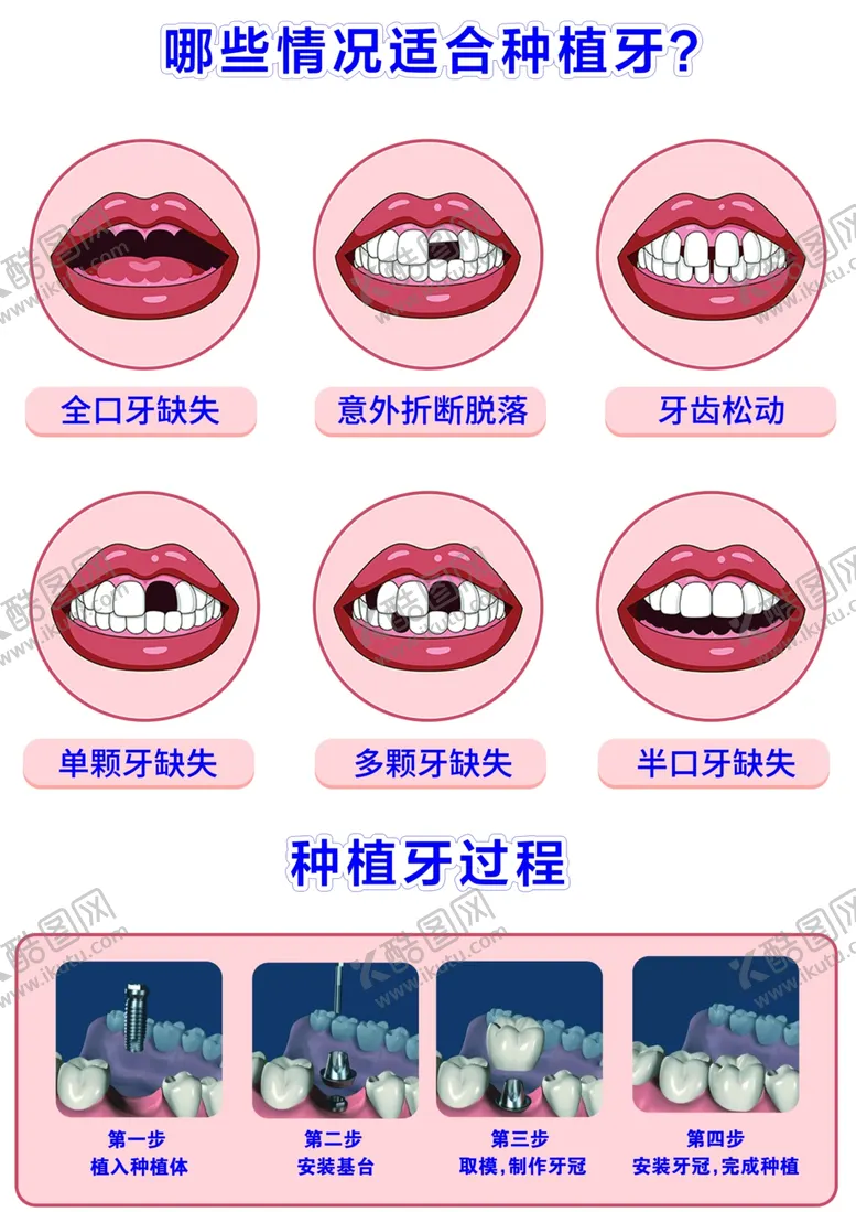 编号：61790602222243392760【酷图网】源文件下载-哪些情况适合种植牙