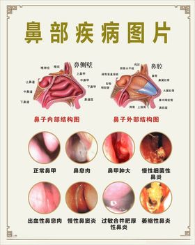 鼻部疾病图片鼻窦炎