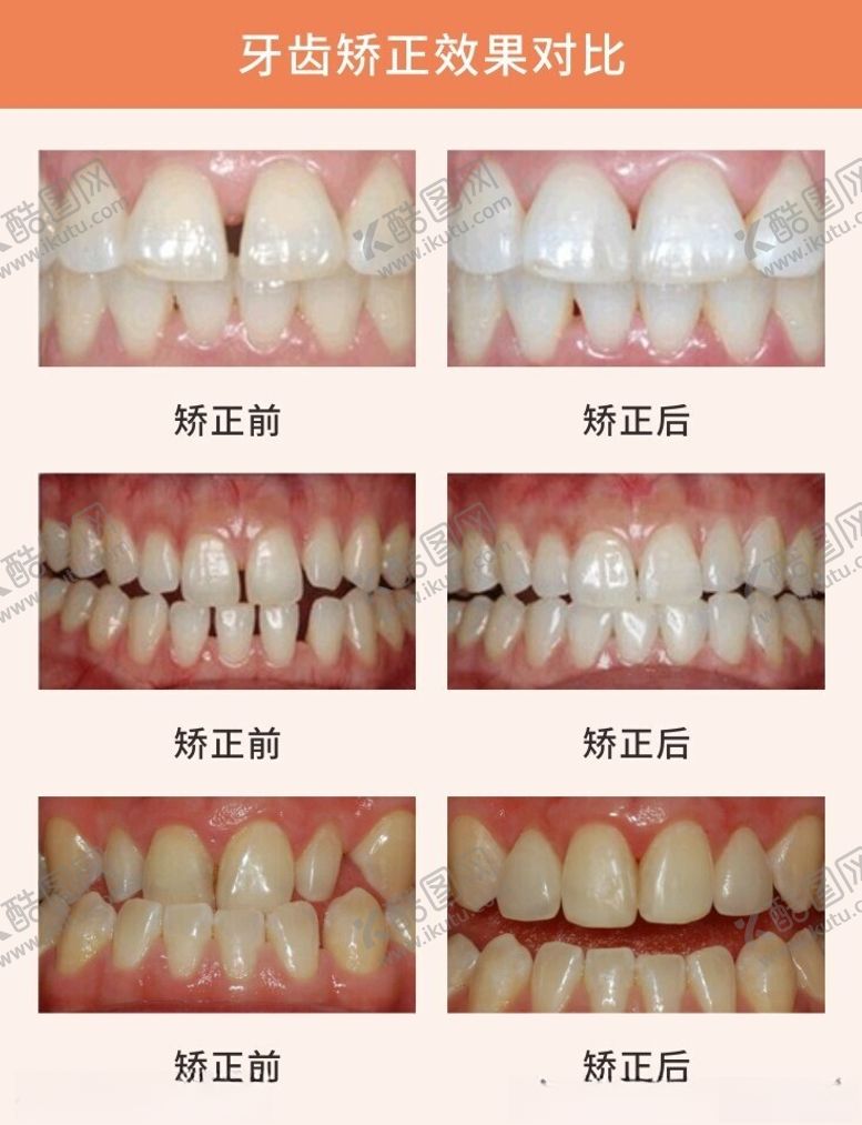 编号：29155102142251407011【酷图网】源文件下载-牙齿矫正效果对比图