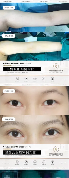 医美整形案例效果系列海报