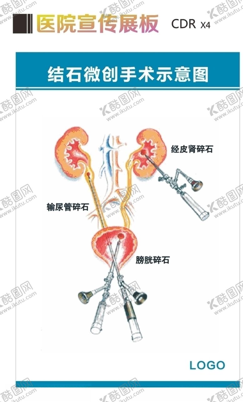 编号：82506709302139153616【酷图网】源文件下载-结石手术示意图
