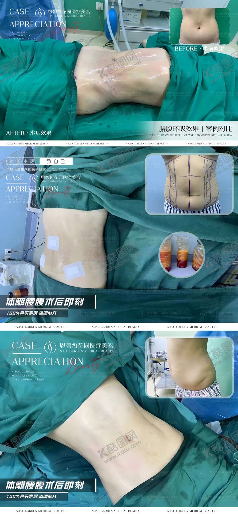 编号：64783211250851246598【酷图网】源文件下载-医美腰腹吸脂案例海报展板