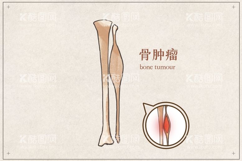 编号：81740411252317319298【酷图网】源文件下载-骨肿瘤