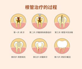 根管治疗插画