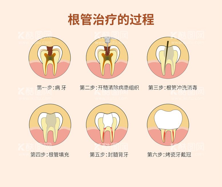 编号：44266811220925138266【酷图网】源文件下载-根管治疗插画