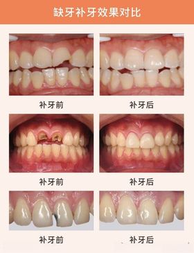 缺牙对比图