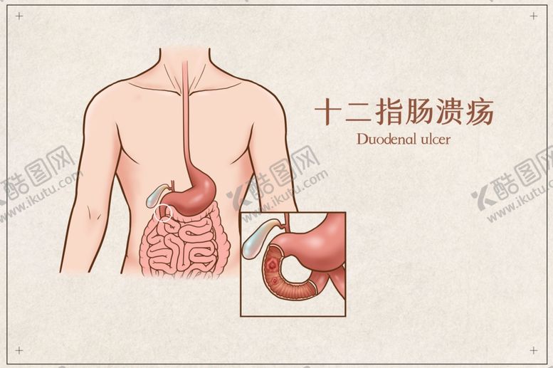 编号：58230001261058136768【酷图网】源文件下载-十二指肠溃疡