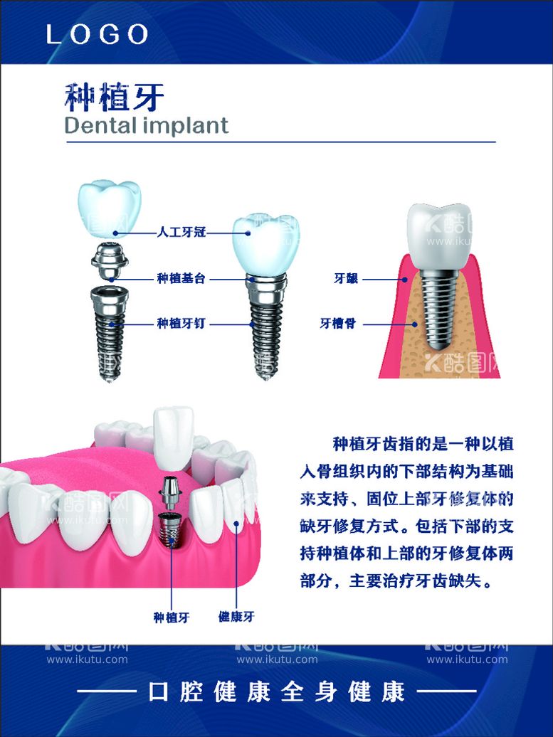 编号：39253001170334285343【酷图网】源文件下载-种植牙